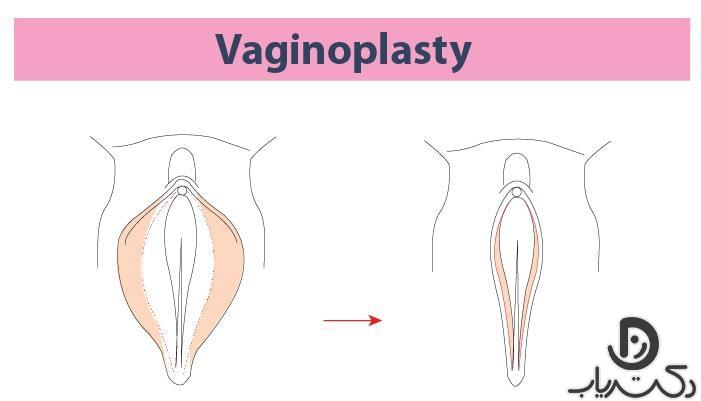 Vaginoplasty2