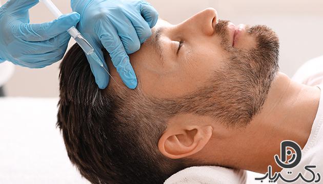 mesotherapy hair