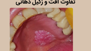 تفاوت آفت دهان و زگیل دهانی