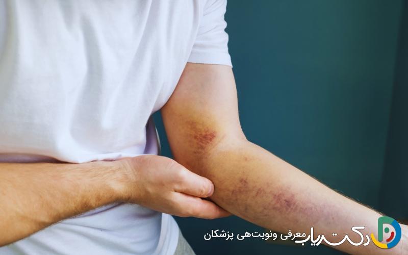 کبودی‌های غیرعادی؛ یکی از نشانه‌های هشداردهنده هموفیلی