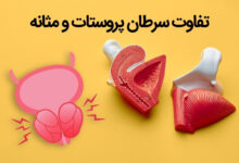تفاوت سرطان مثانه و پروستات