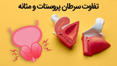 تفاوت سرطان مثانه و پروستات