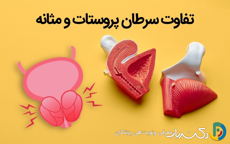 تفاوت سرطان مثانه و پروستات