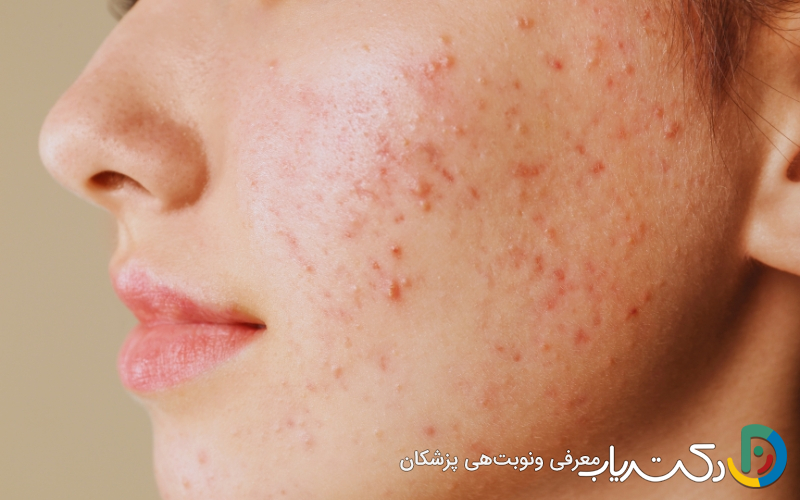 قرص اریترومایسین برای جوش صورت