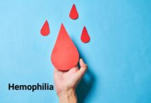 علائم بیماری هموفیلی چیست؟