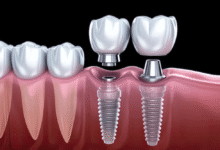 ایمپلنت دندان باعث بهبود اعتماد به نفس می شود؟