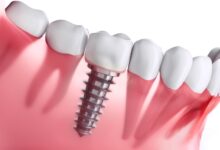 آیا تحقیقات جدید نشان می دهند که ایمپلنت های دندان عملکرد بهتری دارد ؟