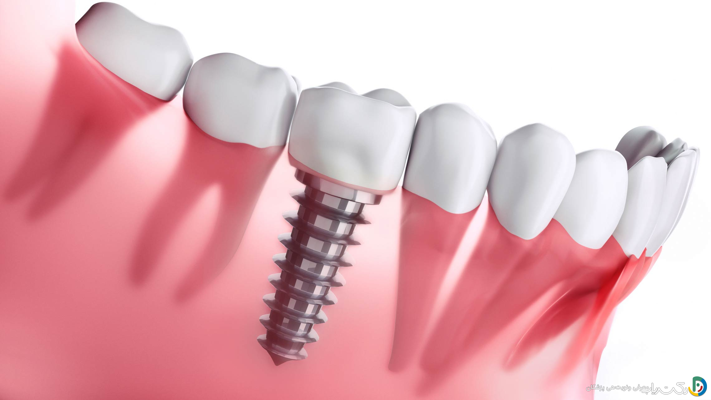 آیا تحقیقات جدید نشان می دهند که ایمپلنت های دندان عملکرد بهتری دارد ؟