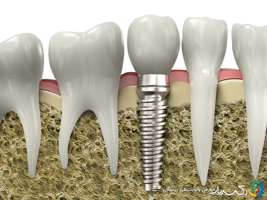 آیا در برخی کشورها ایمپلنت دندان ارزان تر است؟