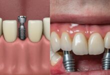 آیا ایمپلنت دندان می تواند باعث آسیب به استخوان شود؟