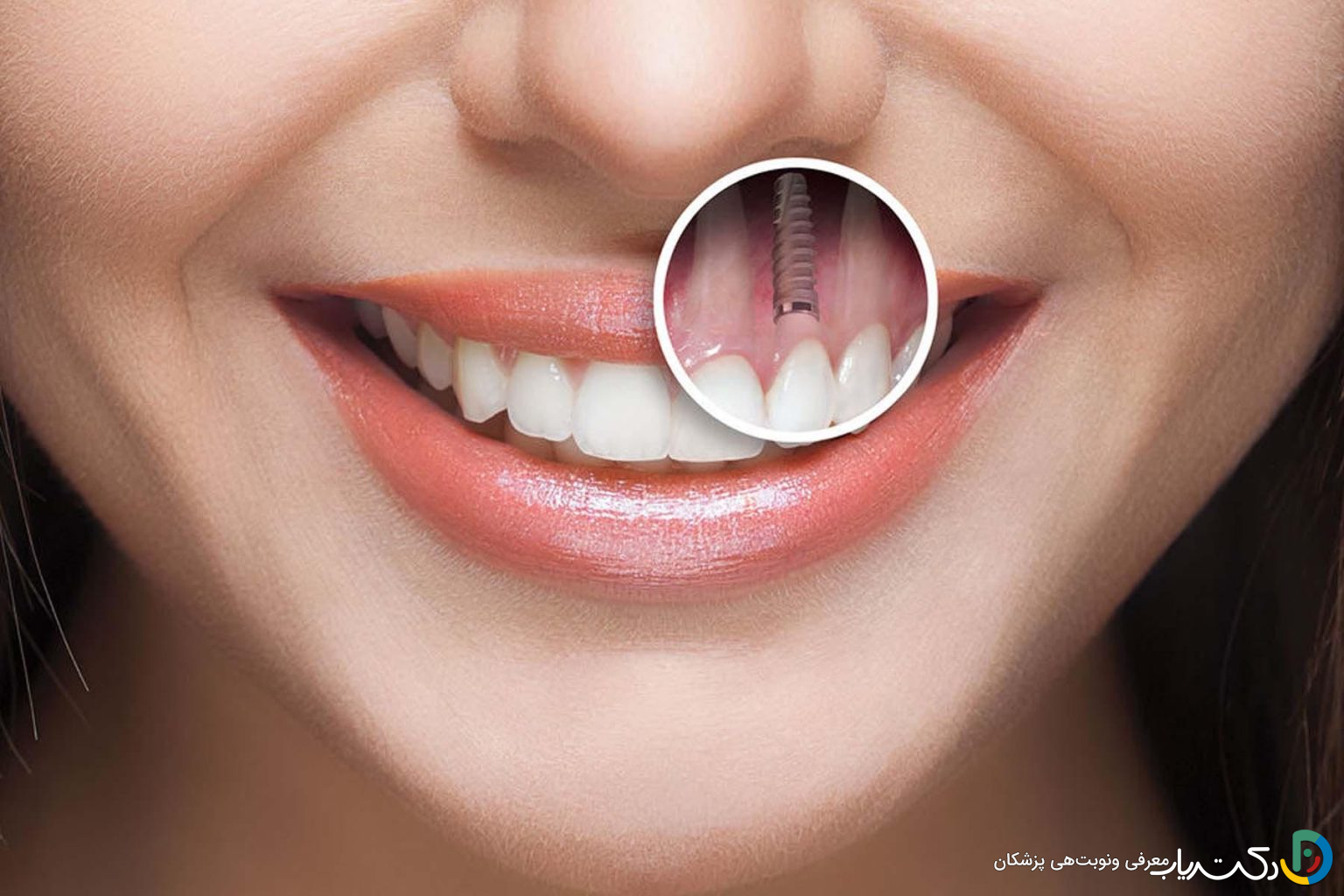 آیا ایمپلنت دندان دردناک است؟