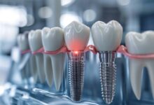 آیا ایمپلنت دندان به طور دائمی باقی می ماند؟