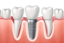 آیا ایمپلنت دندان بهترین گزینه برای ترمیم دندان از دست رفته است؟