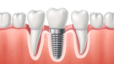 آیا ایمپلنت دندان بهترین گزینه برای ترمیم دندان از دست رفته است؟