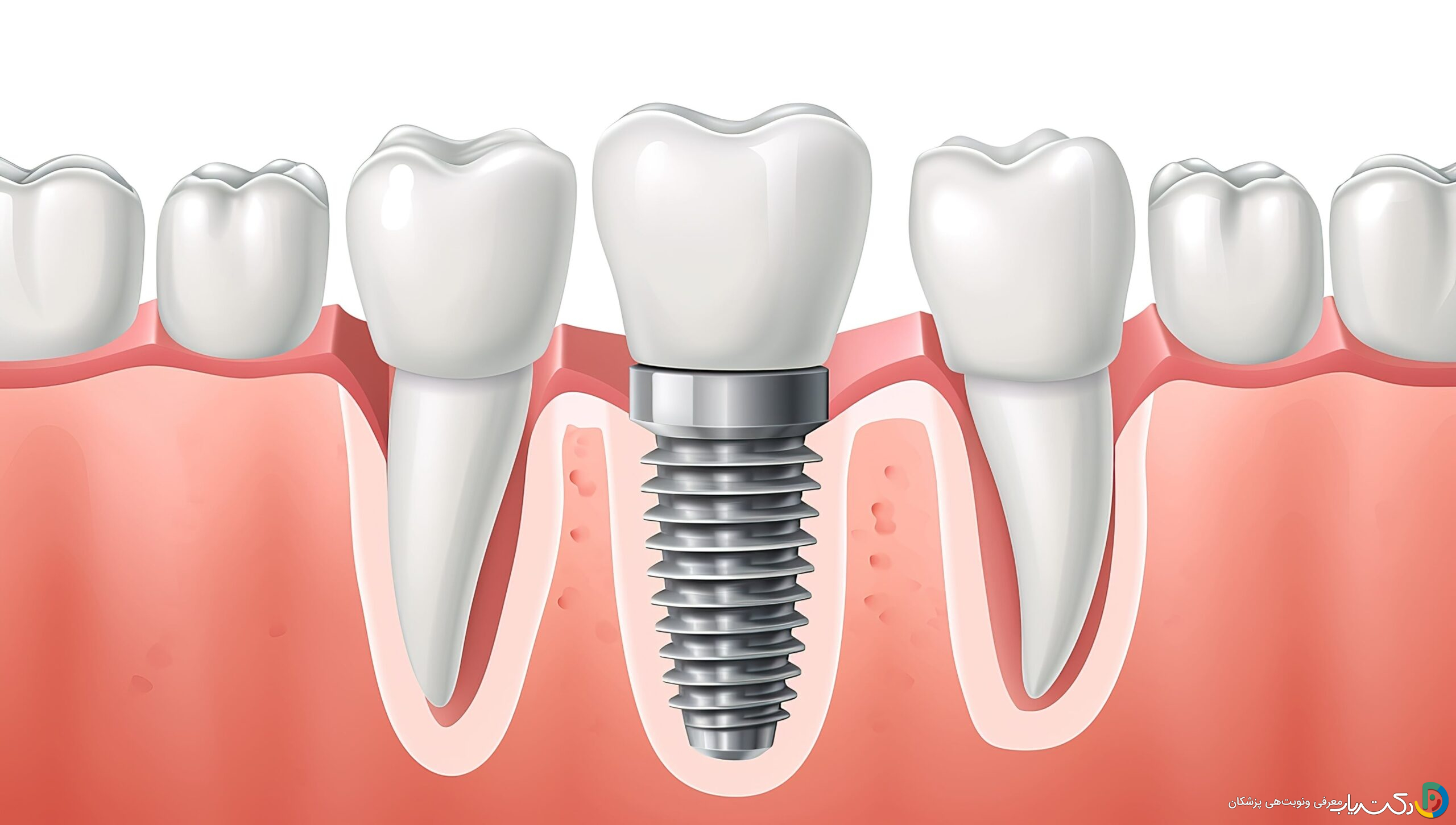 آیا ایمپلنت دندان بهترین گزینه برای ترمیم دندان از دست رفته است؟