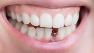 هزینه های اضافی بعد از ایمپلنت دندان چه هستند؟