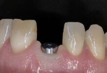 معایب احتمالی ایمپلنت دندان چیست؟