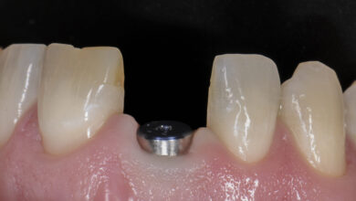 معایب احتمالی ایمپلنت دندان چیست؟