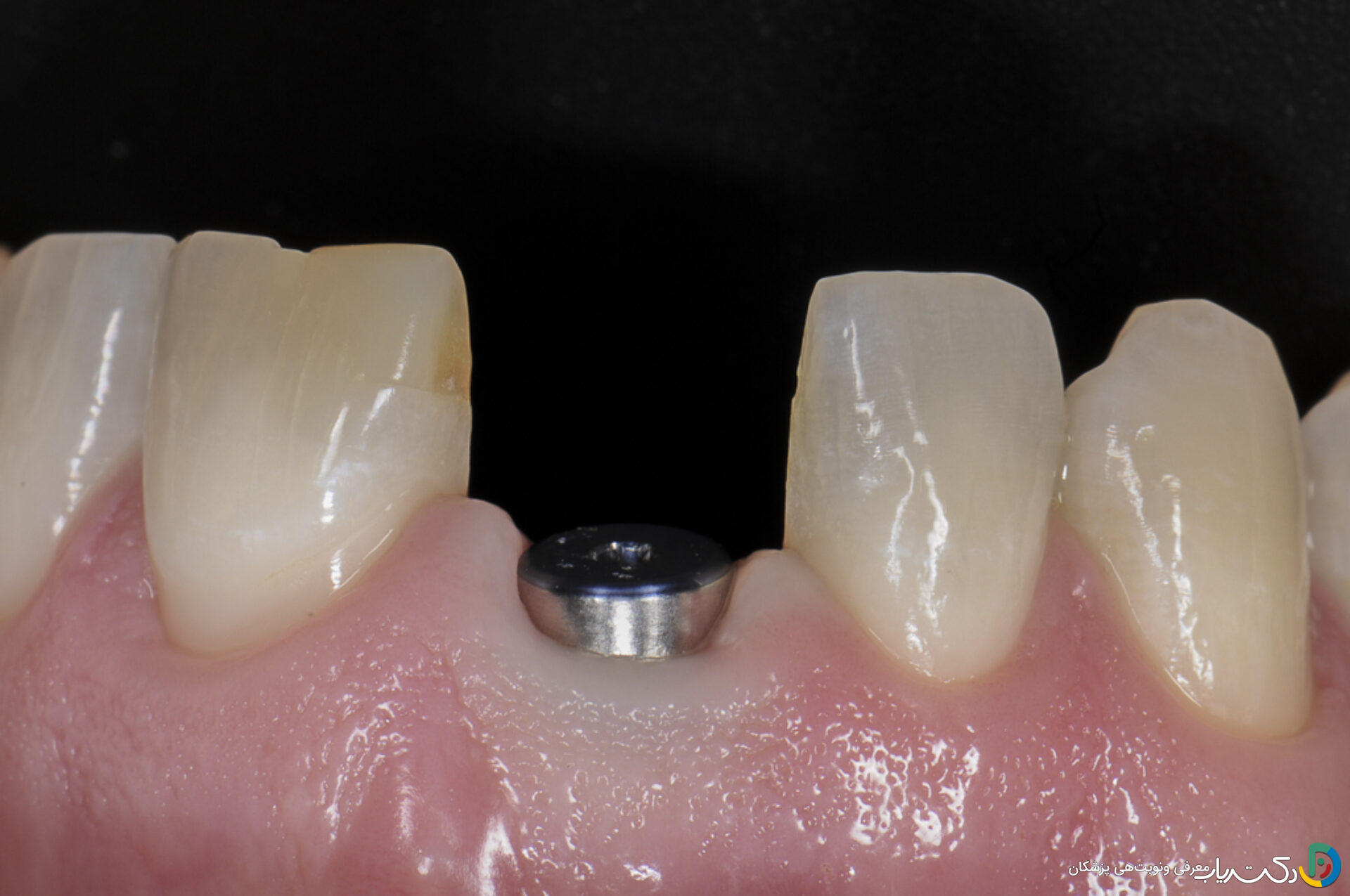 معایب احتمالی ایمپلنت دندان چیست؟