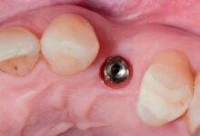 مدت زمان بهبودی بعد از کاشت ایمپلنت دندان چقدر است؟