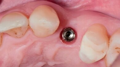 مدت زمان بهبودی بعد از کاشت ایمپلنت دندان چقدر است؟