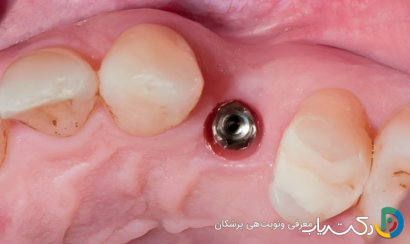 مدت زمان بهبودی بعد از کاشت ایمپلنت دندان چقدر است؟