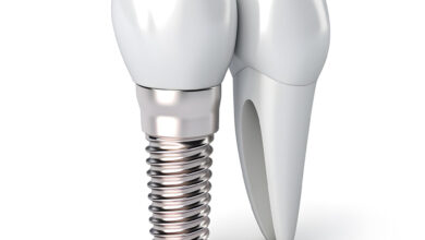 چه کسانی نیاز به ایمپلنت دندان دارند؟