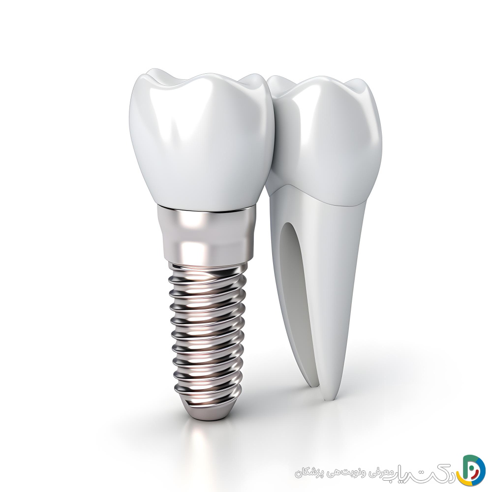 چه کسانی نیاز به ایمپلنت دندان دارند؟