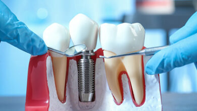 عوارض جانبی ایمپلنت دندان چیست؟