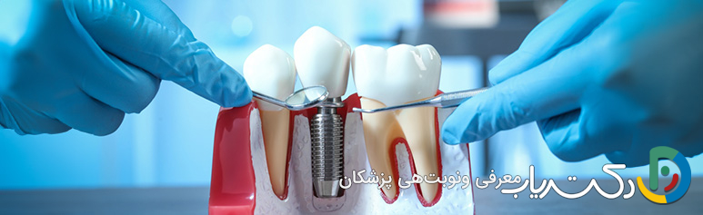 عوارض جانبی ایمپلنت دندان چیست؟