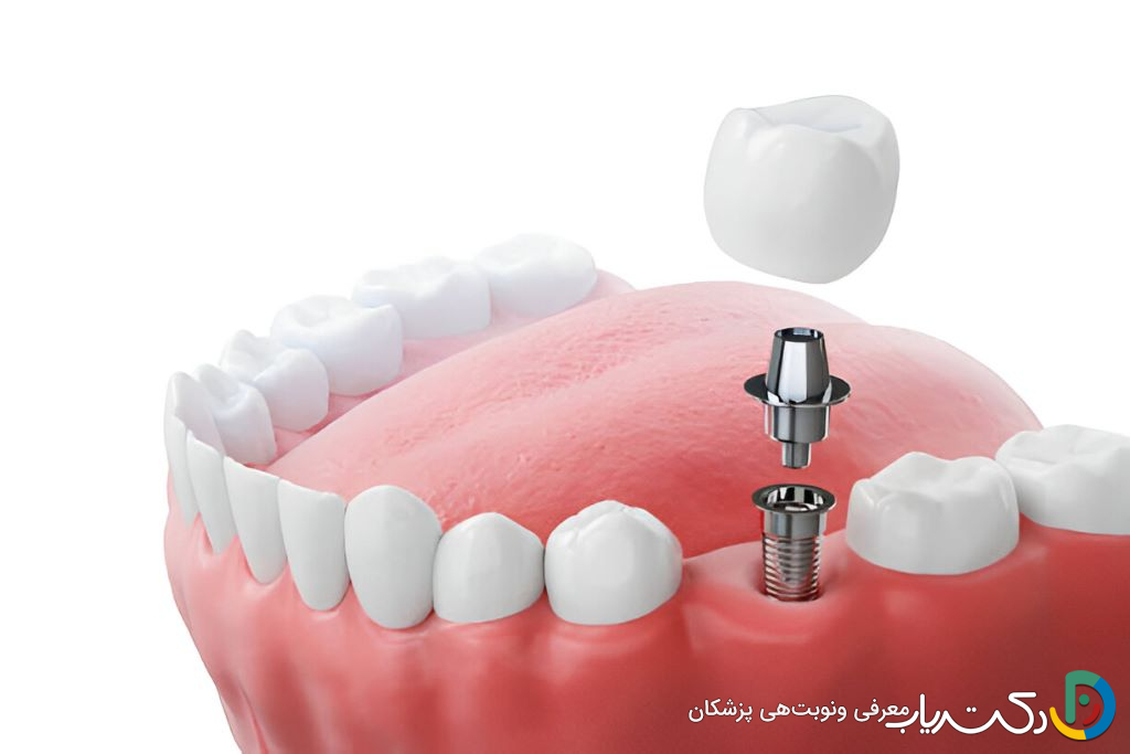 چه کسانی نمی توانند ایمپلنت دندان انجام دهند؟
