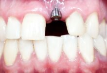 چه عواملی باعث موفقیت ایمپلنت دندان می شود؟