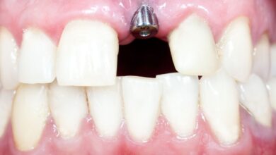 چه عواملی باعث موفقیت ایمپلنت دندان می شود؟
