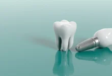 چه خطرات احتمالی در طول یا بعد از عمل ایمپلنت دندان وجود دارد؟