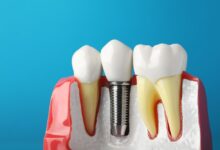 چگونه می توان هزینه ایمپلنت دندان را کاهش داد؟