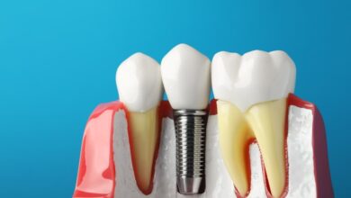 چگونه می توان هزینه ایمپلنت دندان را کاهش داد؟