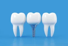 چه اقداماتی برای پیشگیری از عفونت پس از ایمپلنت باید انجام دهیم؟