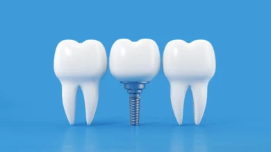 چه اقداماتی برای پیشگیری از عفونت پس از ایمپلنت باید انجام دهیم؟