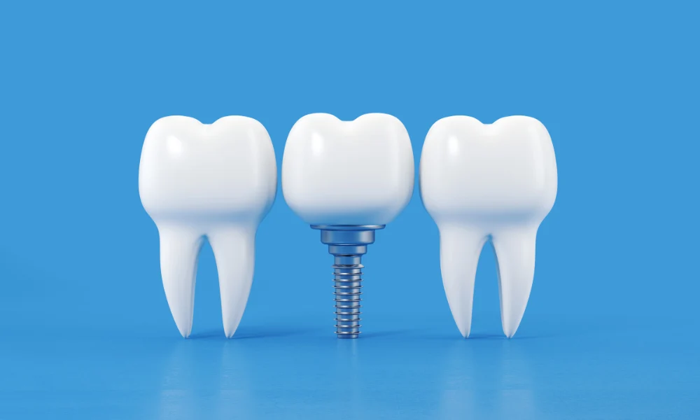 چه اقداماتی برای پیشگیری از عفونت پس از ایمپلنت باید انجام دهیم؟