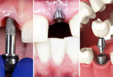 آیا همه ایمپلنت های دندان موفقیت آمیز هستند؟