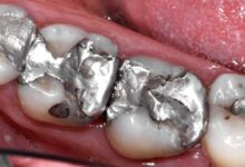 آمالگام (ماده سیاه) چیست؟ هر آنچه باید درباره پرکردگیهای نقرهای بدانید