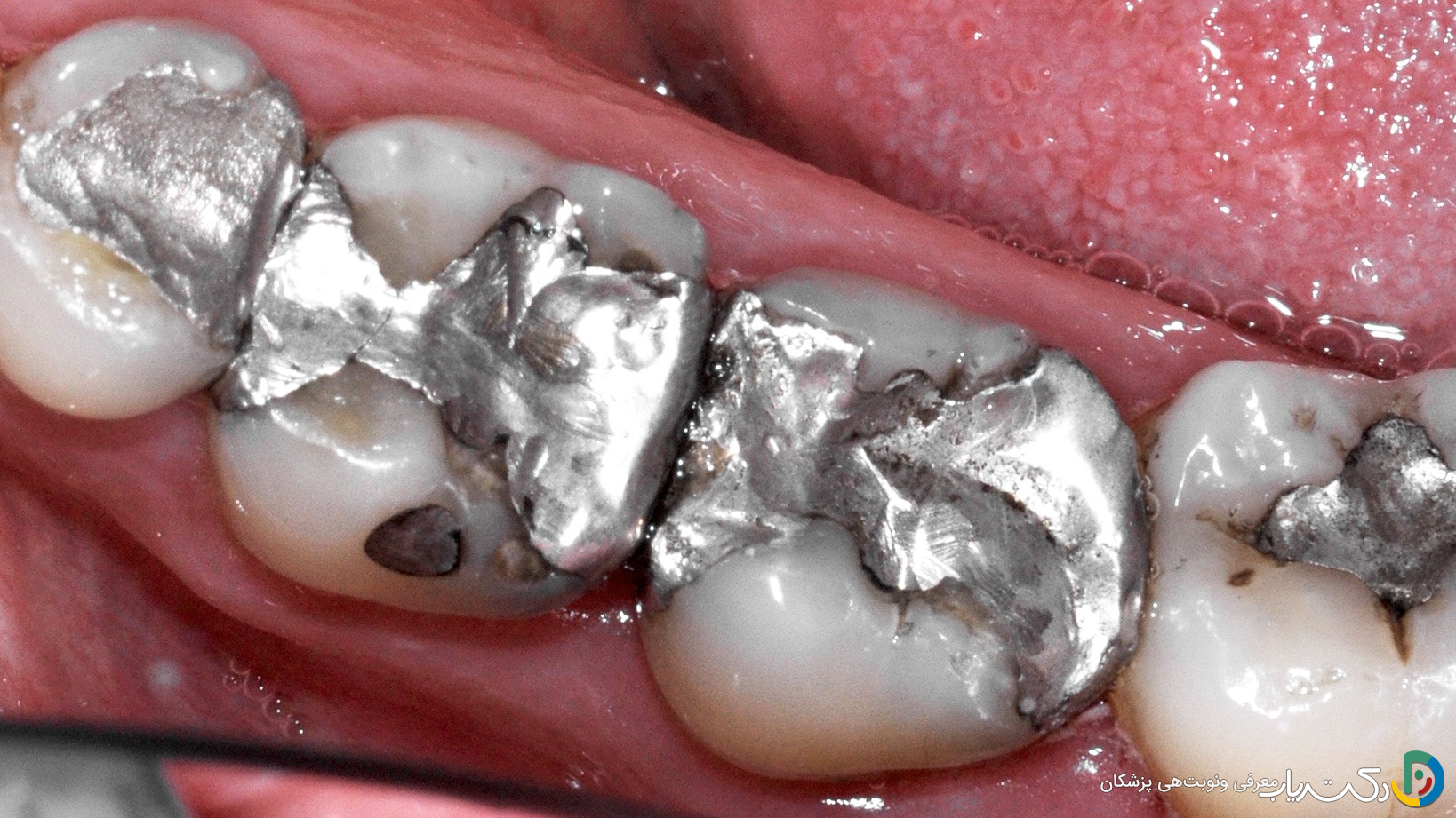 آمالگام (ماده سیاه) چیست؟ هر آنچه باید درباره پرکردگیهای نقرهای بدانید
