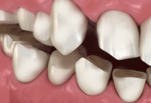 آیا کامپوزیت دندان در درمان مشکلات فکی مؤثر است؟