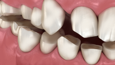 آیا کامپوزیت دندان در درمان مشکلات فکی مؤثر است؟
