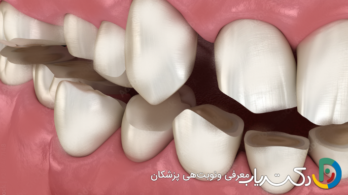 آیا کامپوزیت دندان در درمان مشکلات فکی مؤثر است؟