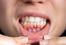 آیا کامپوزیت دندان برای افرادی که مشکلات لثه دارند مناسب است؟