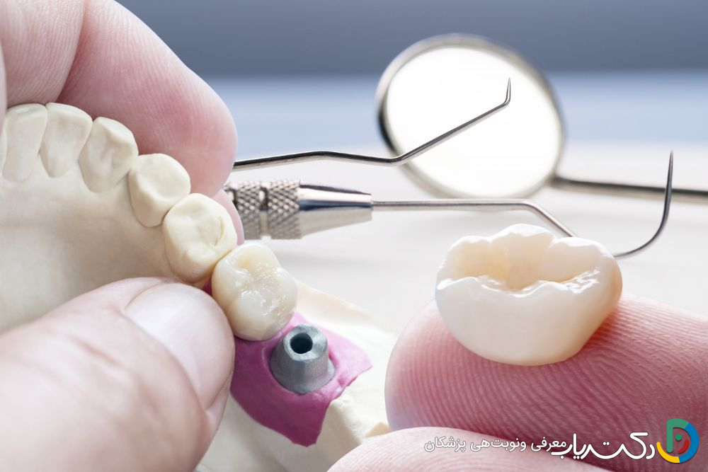 آیا روکش دندان مقاوم به شکست است؟