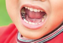 آیا روکش دندان برای کودکان مناسب است؟