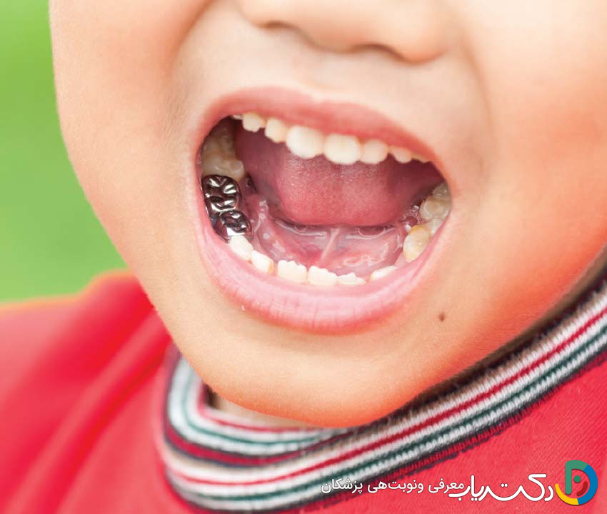 آیا روکش دندان برای کودکان مناسب است؟
