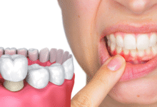 آیا روکش دندان برای کسانی که مشکلات لثه دارند مناسب است؟